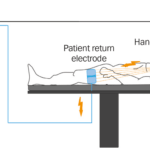 Electrosurgery vs traditional lancet-based surgery.